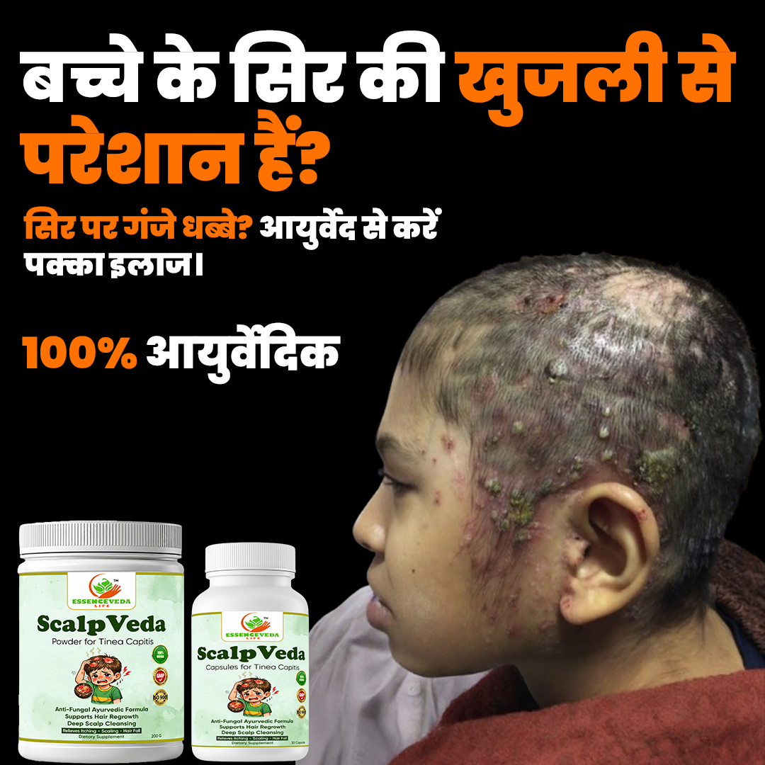 बच्चे के सिर में गंजे पैच – Tinea Capitis
