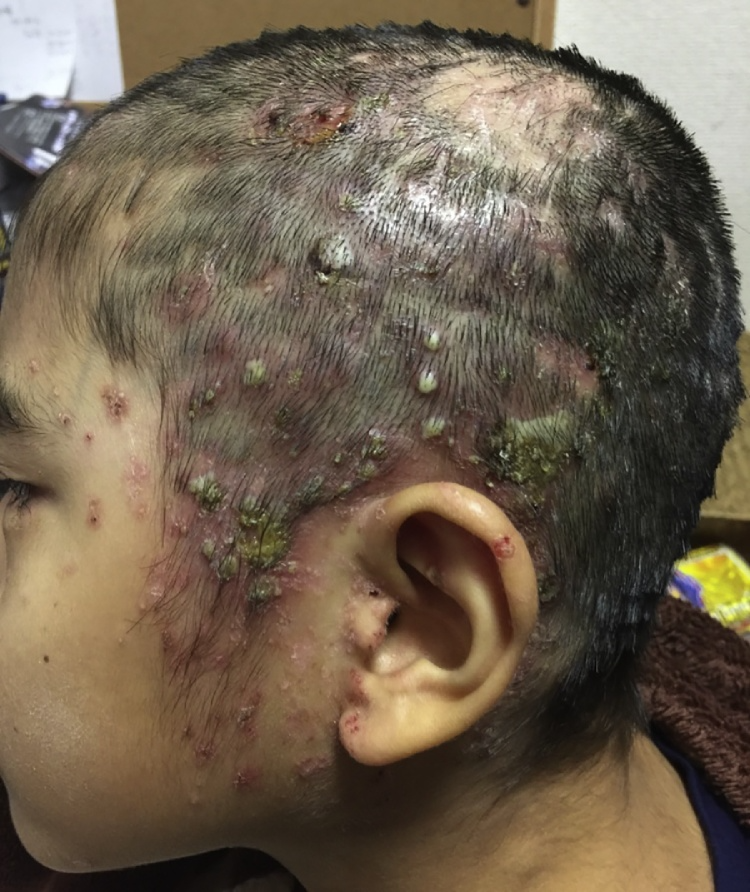 पस भरे दाने