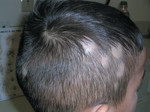 सिर में गोल गंजे पैच